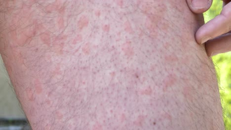 colmenas en las piernas del hombre caucásico