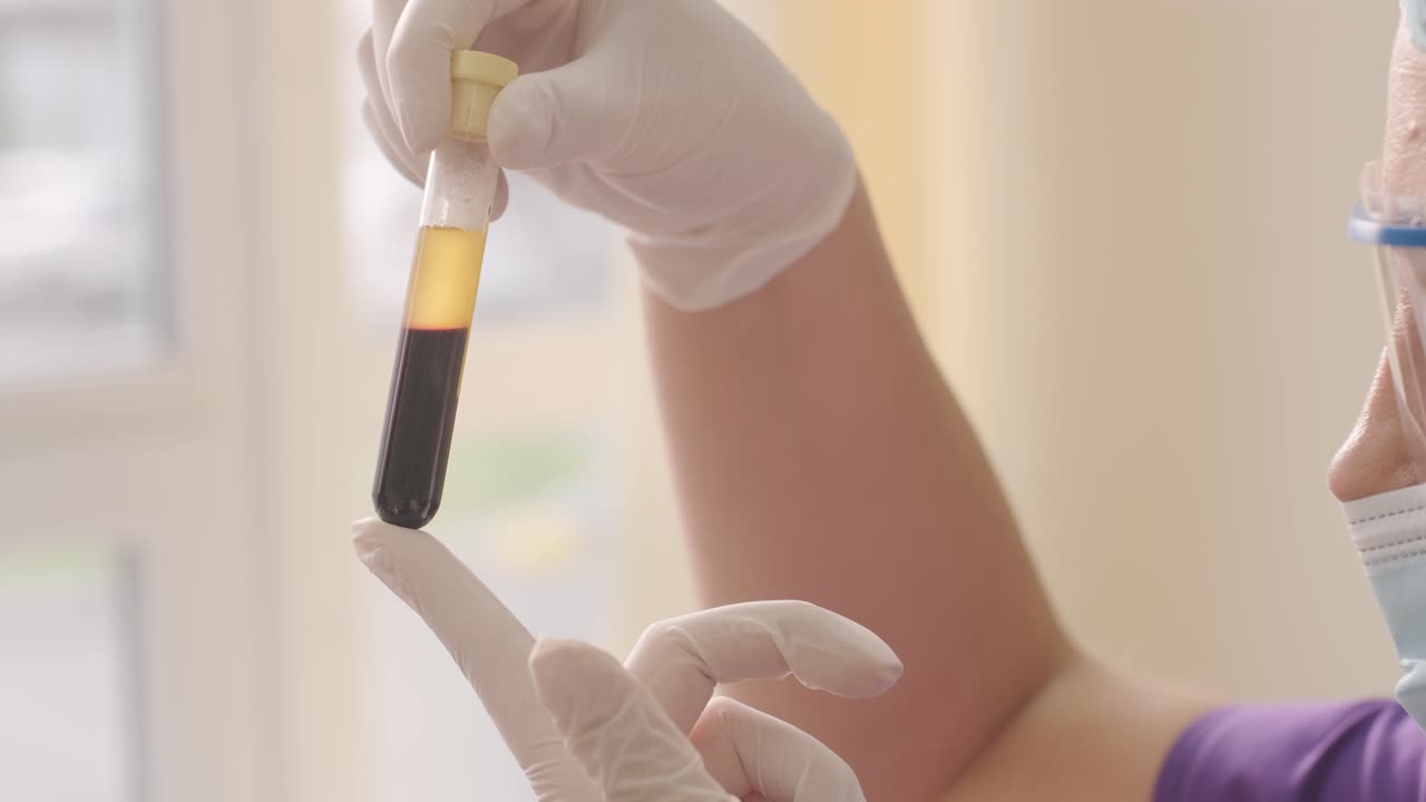 preparación de plasma rico en plaquetas. tubo con sangre en las manos.