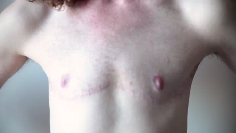 transgender man showing surgery scars on chest