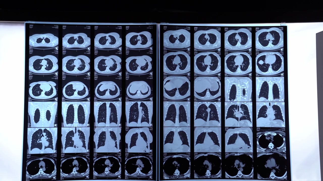 Immagini di TAC mediche di polmoni e torace umani