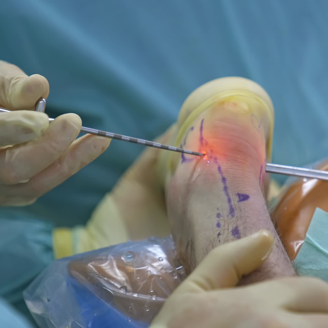 Medical team hands performing operation. Team of professional doctors operating surgery in hospital room