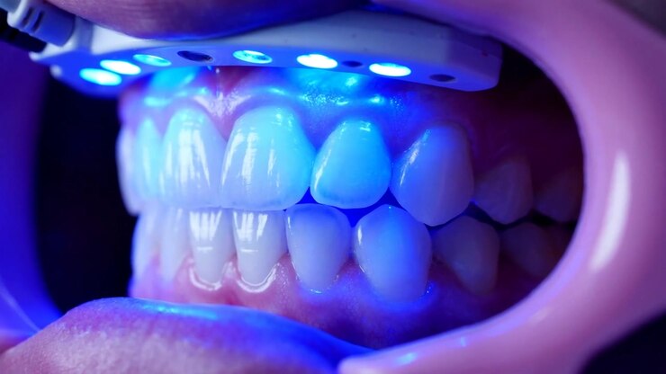 Close-up of Teeth Whitening Procedure with Blue LED Light