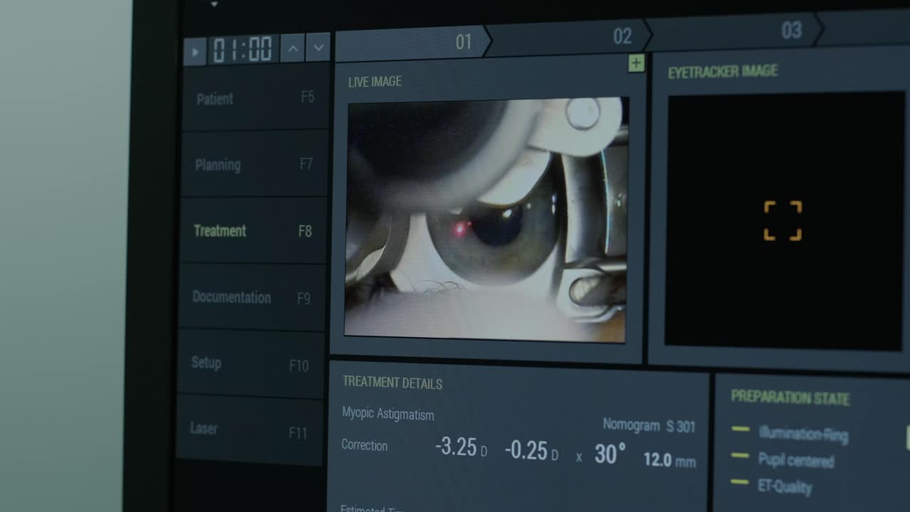 Ophthalmic surgery. View on the screen of medical monitor in operating room. Lasik