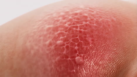 close-up of sunburn or skin irritation