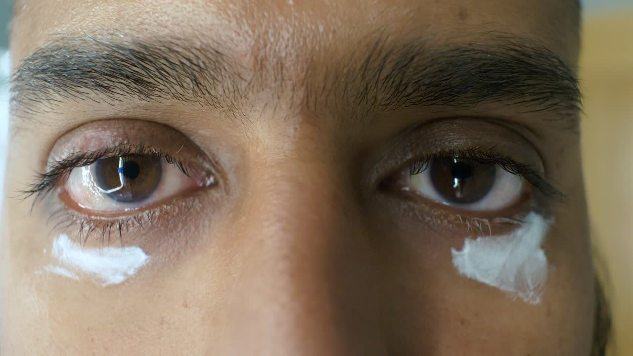 hombre indio del sudeste asiático aplicando crema en el área del vitiligo debajo de los ojos