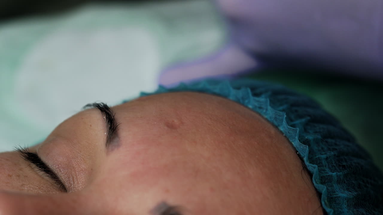 Cosmetologist applies tool for blackhead removal on client's forehead. Beauty and skincare procedures. Extreme close up.