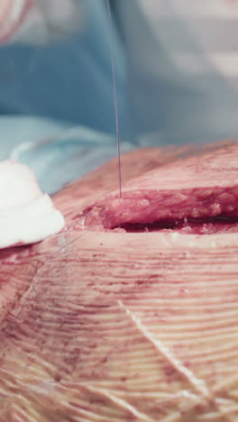 surgeon hands close skin facial layer. skilled medic use absorbable sutures closing chest incision after successful coronary artery bypass surgery closeup