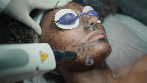 procedimiento de peeling facial de primer plano con equipo láser. cosmetólogo que trata la piel