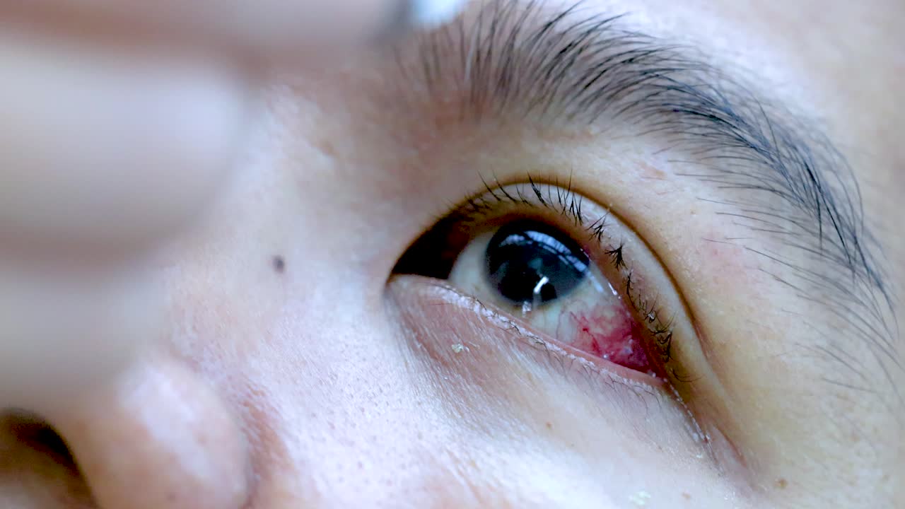 Person applies eye drops to irritated, red eye in bright, clinical lighting, extreme close-up view