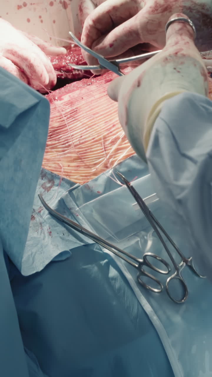 Surgical team closes chest incision. Cardiothoracic surgeons with assistant connect sides of cavity using sutures after coronary artery bypass surgery