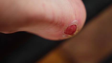 zoomed-in of a red blister on person’s heel due to rubbing from shoes