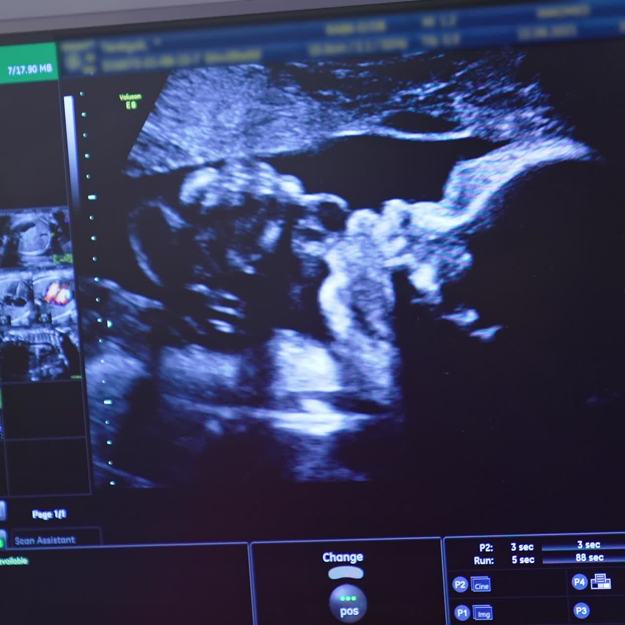 Ultrassom de bebê no útero da mãe. Ultrassom de gestante. Análise científica.