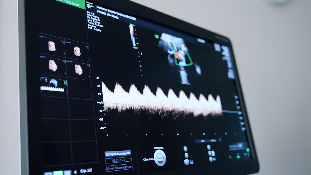 Heartbeat rate line shown on the screen of ultrasound machine. Close up. Pregnancy examination in the hospital.