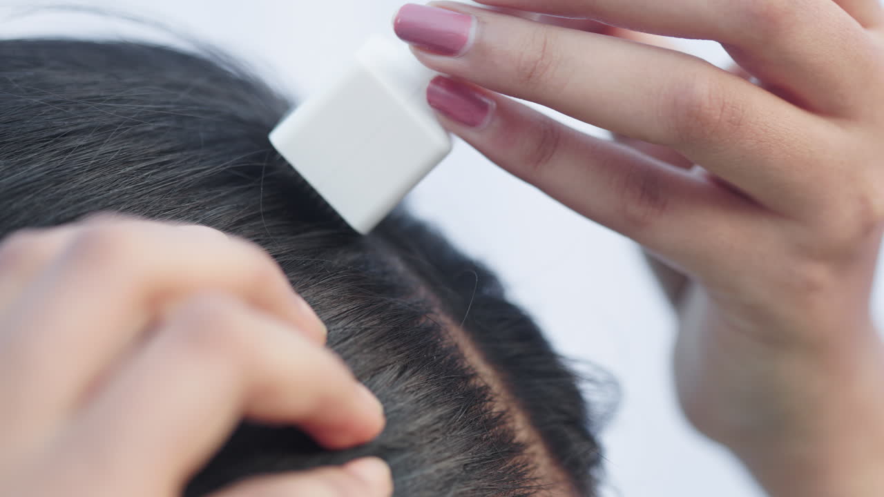 Collagen induction therapy, hair loss, microneedling treatment, a woman using derma stamp on her head for stimulating new hair growth.