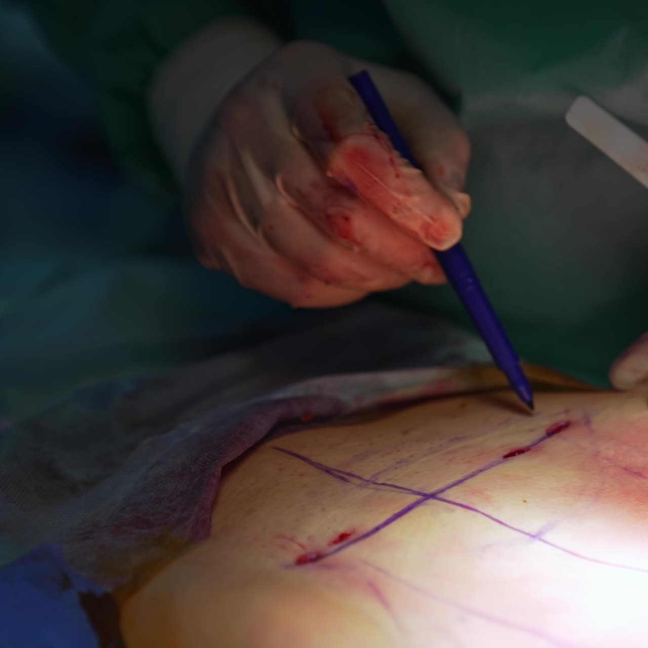 Doctor draws lines on patient's abdomen with a marker. Surgeon marks problem parts on a belly for further liposuction. Close-up