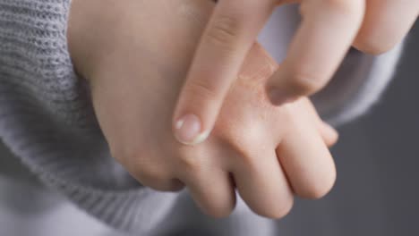 A-woman-with-redness-and-allergies-on-her-hands-applies-cream.