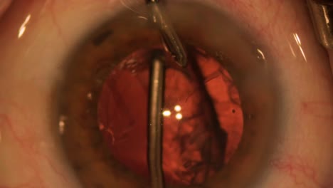 eye surgery, vitreoretinal. vitrectomy surgery.