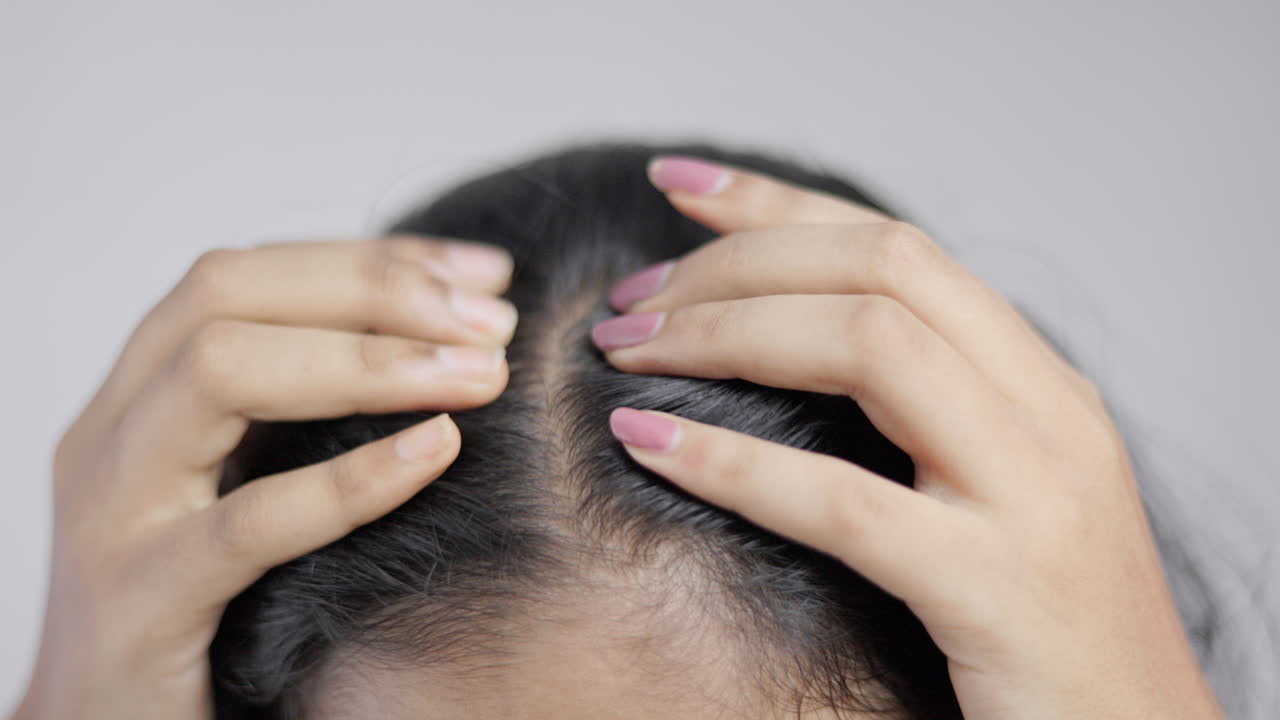 woman showing her alopecia head in white background