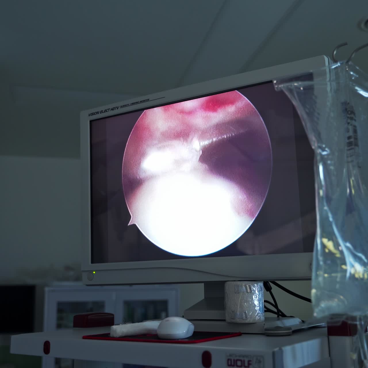 Screen in surgery room showing the minimal invasion instrument moving in the patient's organ. Low angle view