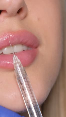 lip fillers procedure