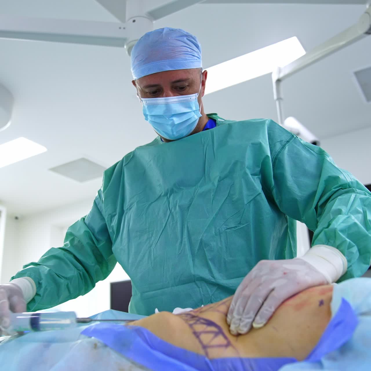 Surgeon performs abdominal liposuction in modern hospital. Doctor thrusting huge syringe with medicines into patient's abdomen. Low angle view