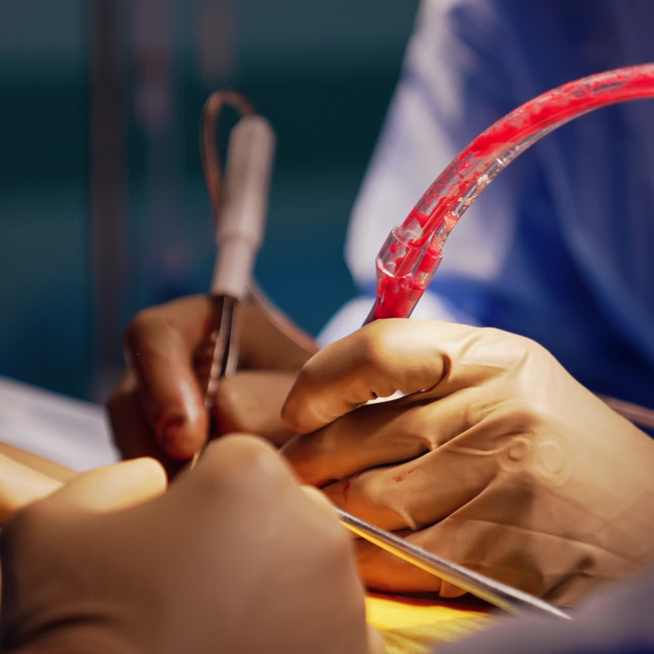 Le mani di un chirurgo che indossa guanti in lattice utilizzano un moderno strumento medico. Tubo di uno strumento con sangue che si muove all'interno. Primo piano