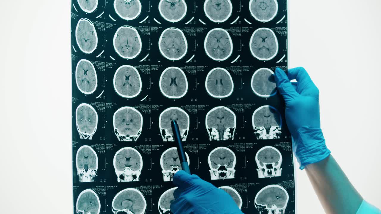 Medico con guanti che esamina una TAC del cervello umano