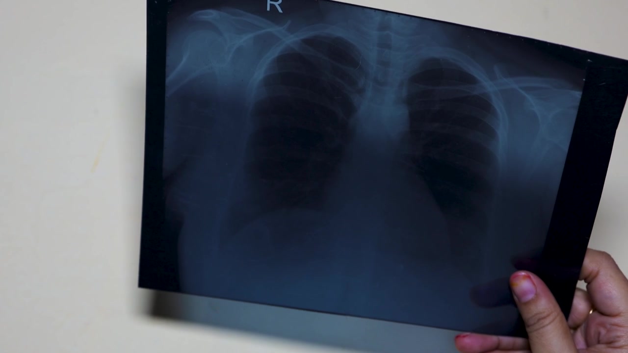 Close Up Of Chest X Ray Image Held By Hand During Medical Health Assessment