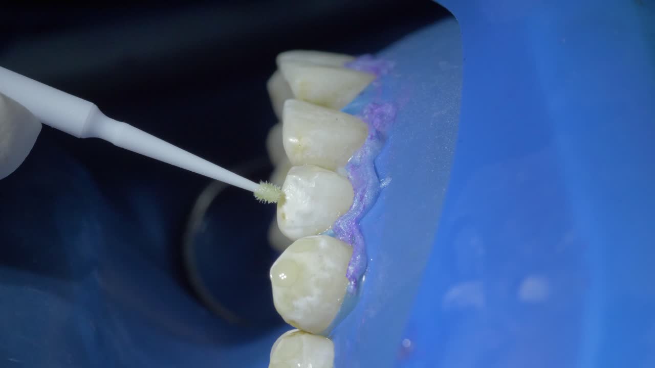 observe de cerca el proceso detallado de limpieza de los dientes mientras un dentista utiliza hábilmente las herramientas
