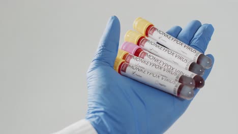 mano de un médico sosteniendo viales con el virus de la viruela del mono