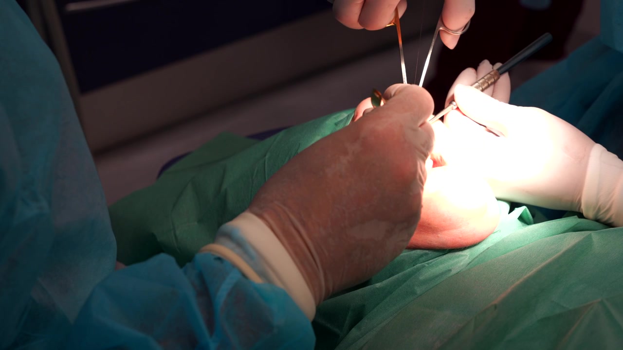 I medici suturano la gengiva di un paziente e tagliano il filo dopo l'estrazione del dente, inquadratura statica media.