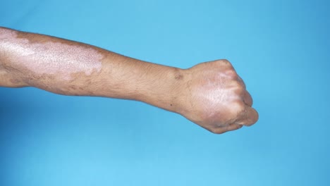 skin condition on arm and hand