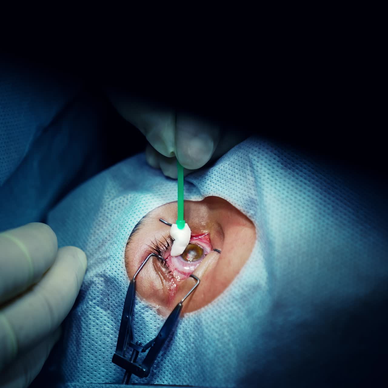 corrección de la visión con láser. un paciente y un equipo de cirujanos en la sala de operaciones durante una cirugía oftalmológica. especulo del párpado. tratamiento de lasik. paciente bajo una cubierta estéril