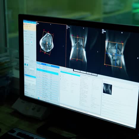medical specialist examining patient's bones on monitor. female doctor is looking at scans of a patient on computer screen in clinic.
