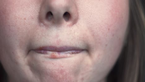 woman with cold sores on her lips