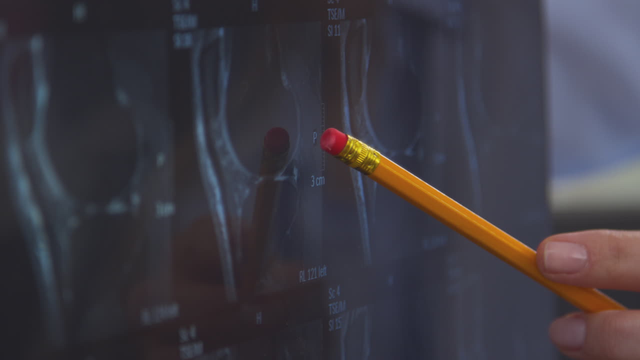 사무실에서 ct 또는 mri 스캔을 연필로 가리키는 여성 의사 또는 gp의 클로즈업