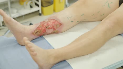 application of bioglue in surgical treatment of leg ulcer