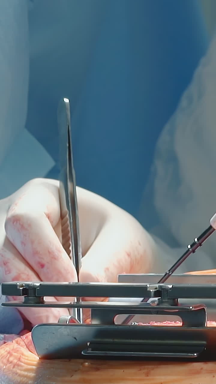 el médico realiza una cirugía con láser en la clínica de primer plano. el cirujano en guantes opera con pinzas y bisturí caliente durante la cirugía de bypass de la arteria coronaria en la habitación