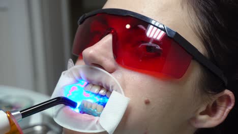 Young-woman-with-an-expander-in-mouth-and-red-protective-glasses-getting-UV-whitening-at-the-dentist's-office-by-an-ultra-violet-machine.-Shot-in-4k