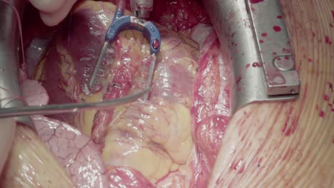 surgeon is installing a shunt in the myocardium 2