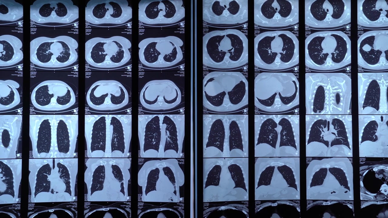 Diverse scansioni TC che mostrano polmoni umani per diagnosi medica