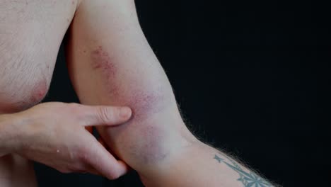 detailed closeup of a bruised biceps and shoulder with tendon damage. deep discoloration from internal bleeding as hand gently examines the affected area