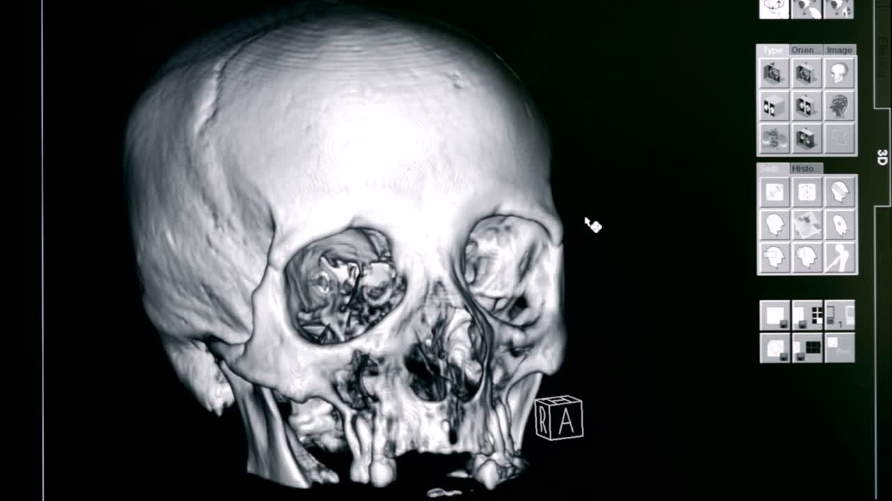 3D model of a skull, close up. Hospital equipment makes a 3D model of a person's skull.