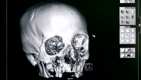 3d model of a skull, close up. hospital equipment makes a 3d model of a person's skull.