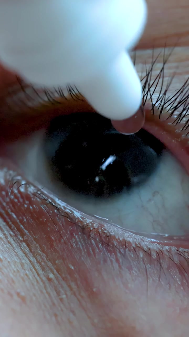 Macro video of human eye receiving lubricating medical eye drops, static camera, clinical lighting
