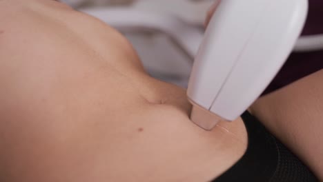 laser hair removal procedure on the abdomen
