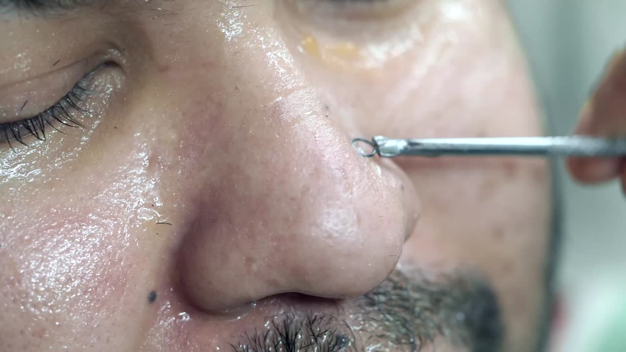 Facial Treatment - Nose Extraction