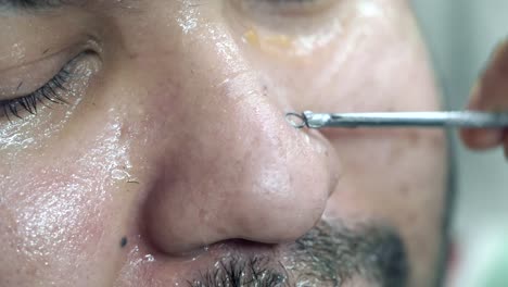 facial treatment - nose extraction