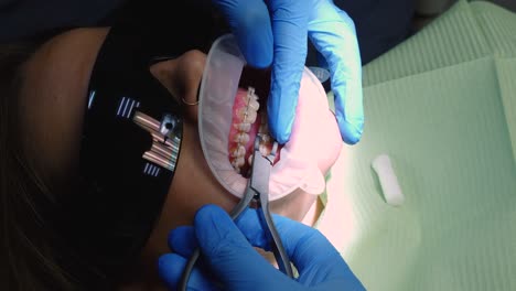 braces removal process