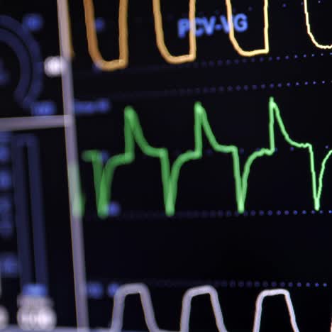 patient's condition on health monitor. vital signs on anesthesia surgery monitor in intensive care unit. colored lines on screen. medicine and critical care. close-up.